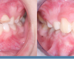 before and after teeth orthodontist Redding CA