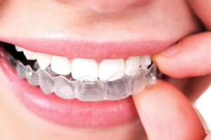 Woman holding Invisalign aligners up to her mouth