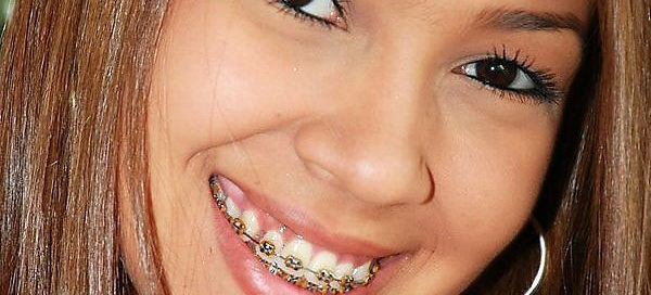 teenage girl with braces