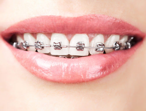 3 Main Reasons to Consider Getting Braces in Redding