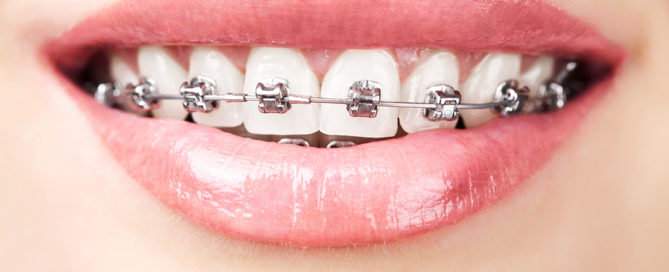 teeth with braces